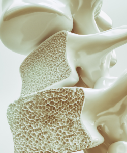 Anatomický rez stavca zobrazujúci zníženú hustotu kostí spojenú s osteoporózou.